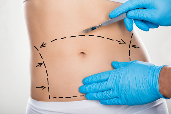 Abdominoplastik Wiesbaden